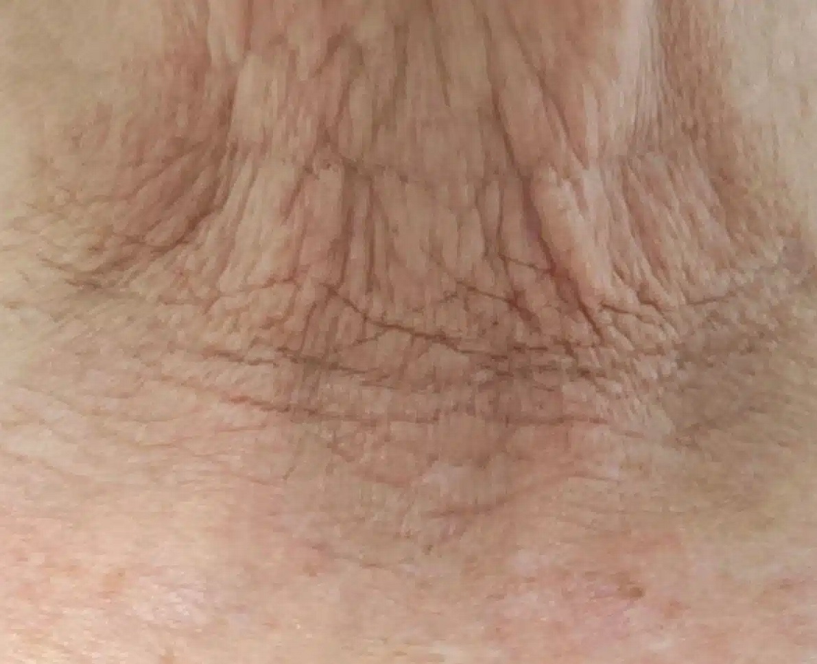 Ageing Neck