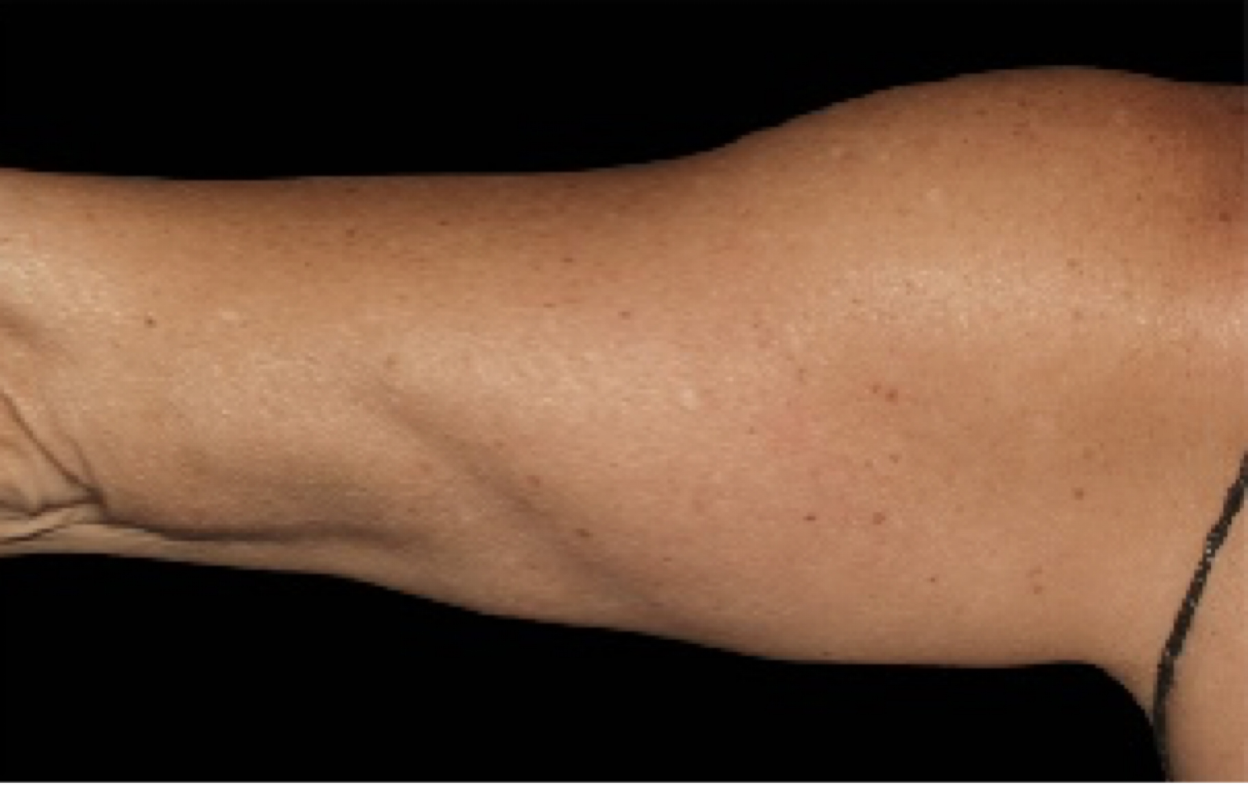 coolsculpting arm fat removal