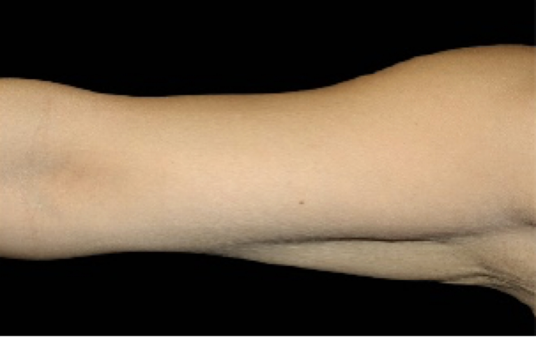 coolsculpting for arms before and after
