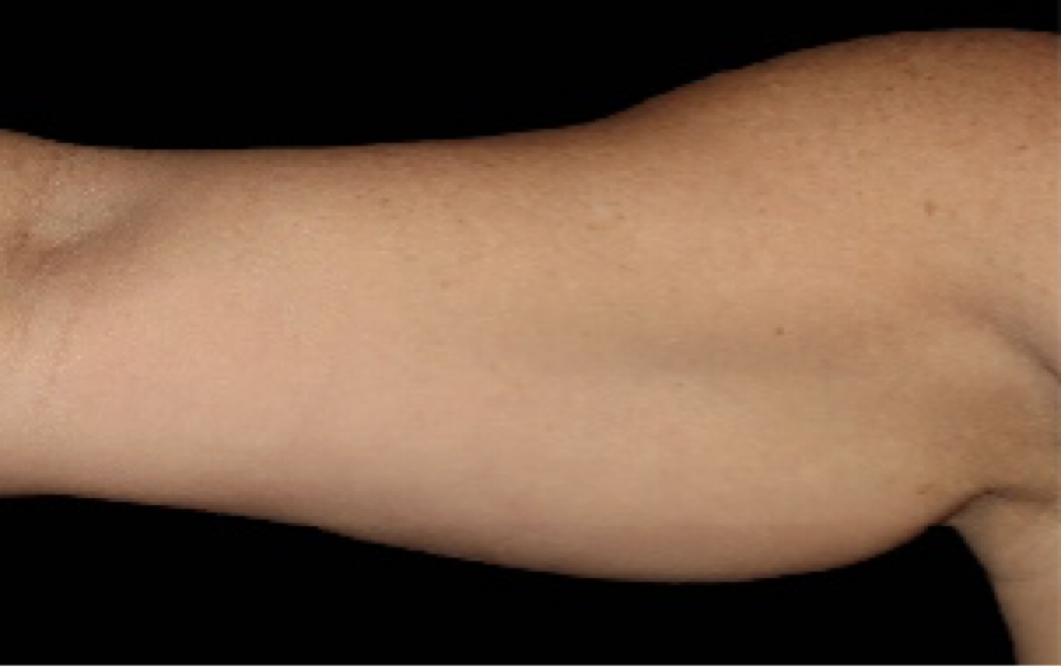 coolsculpting, arms before and after