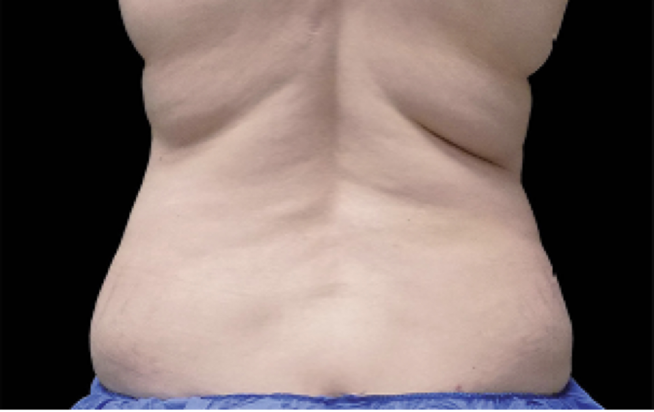 back fat removal clinic