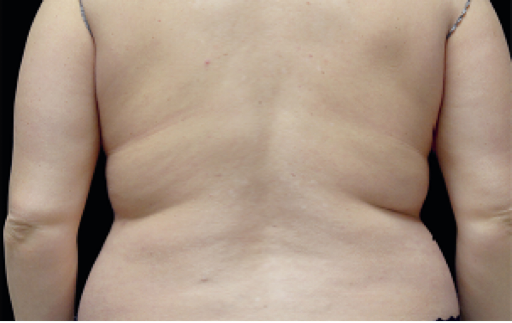 back fat removal before and after