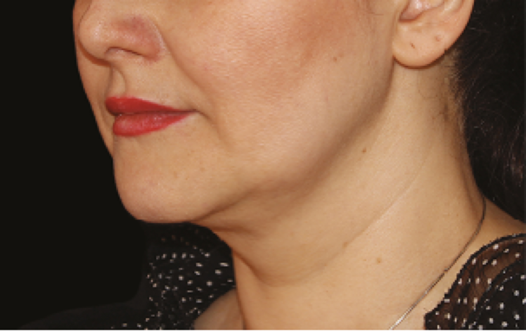 coolsculpting double chin