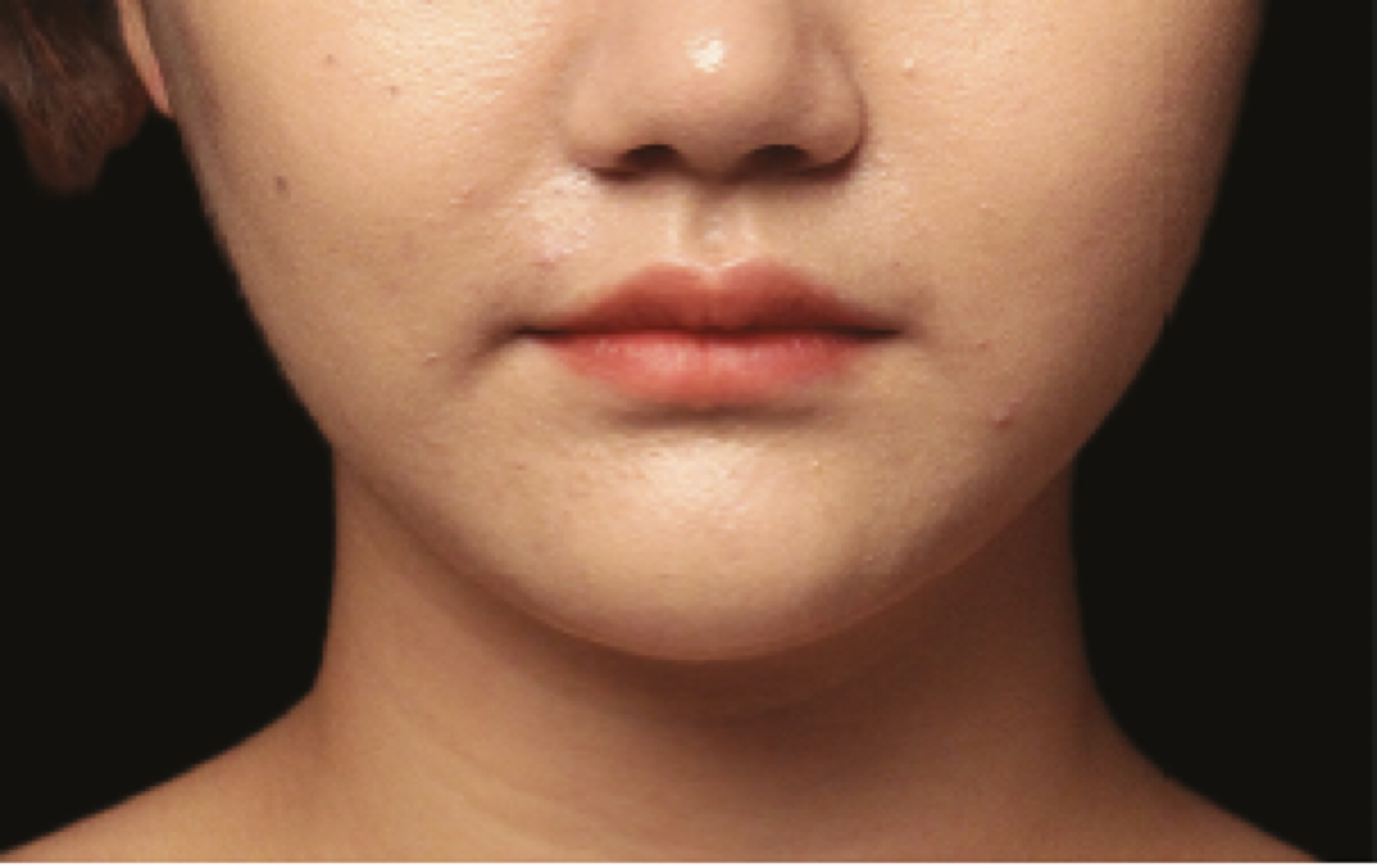 coolsculpting double chin fat freezing