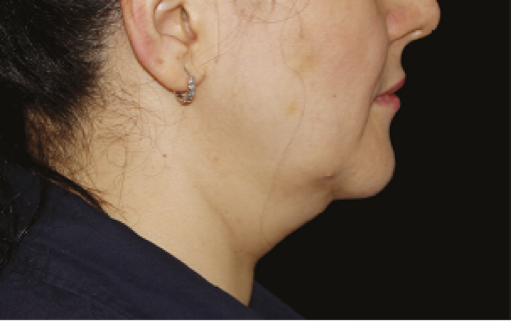 coolsculpting double chin fat freezing