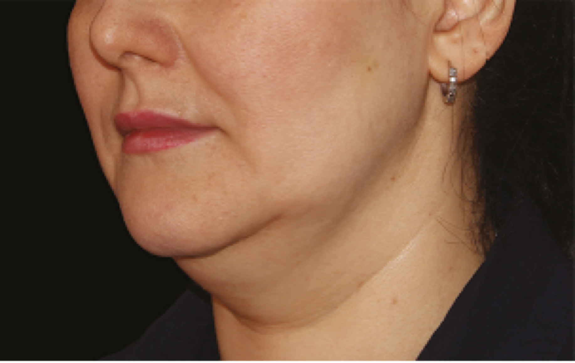 coolsculpting double chin