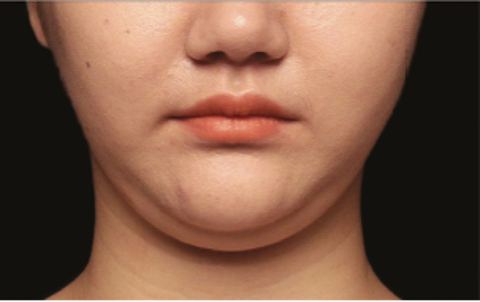 coolsculpting double chin