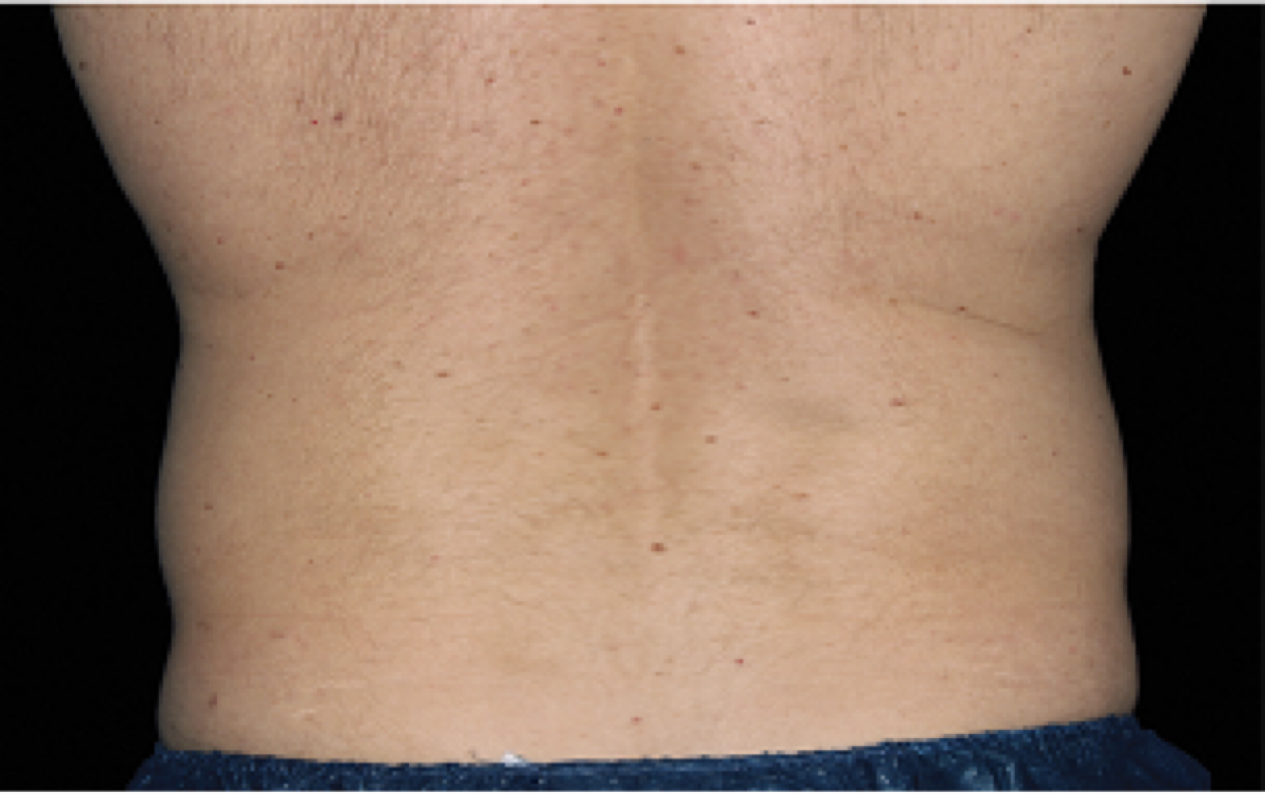 CoolSculpting Elite flank removal