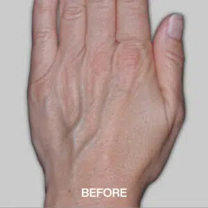 Hand-Rejuvenation-before-300x300.jpg