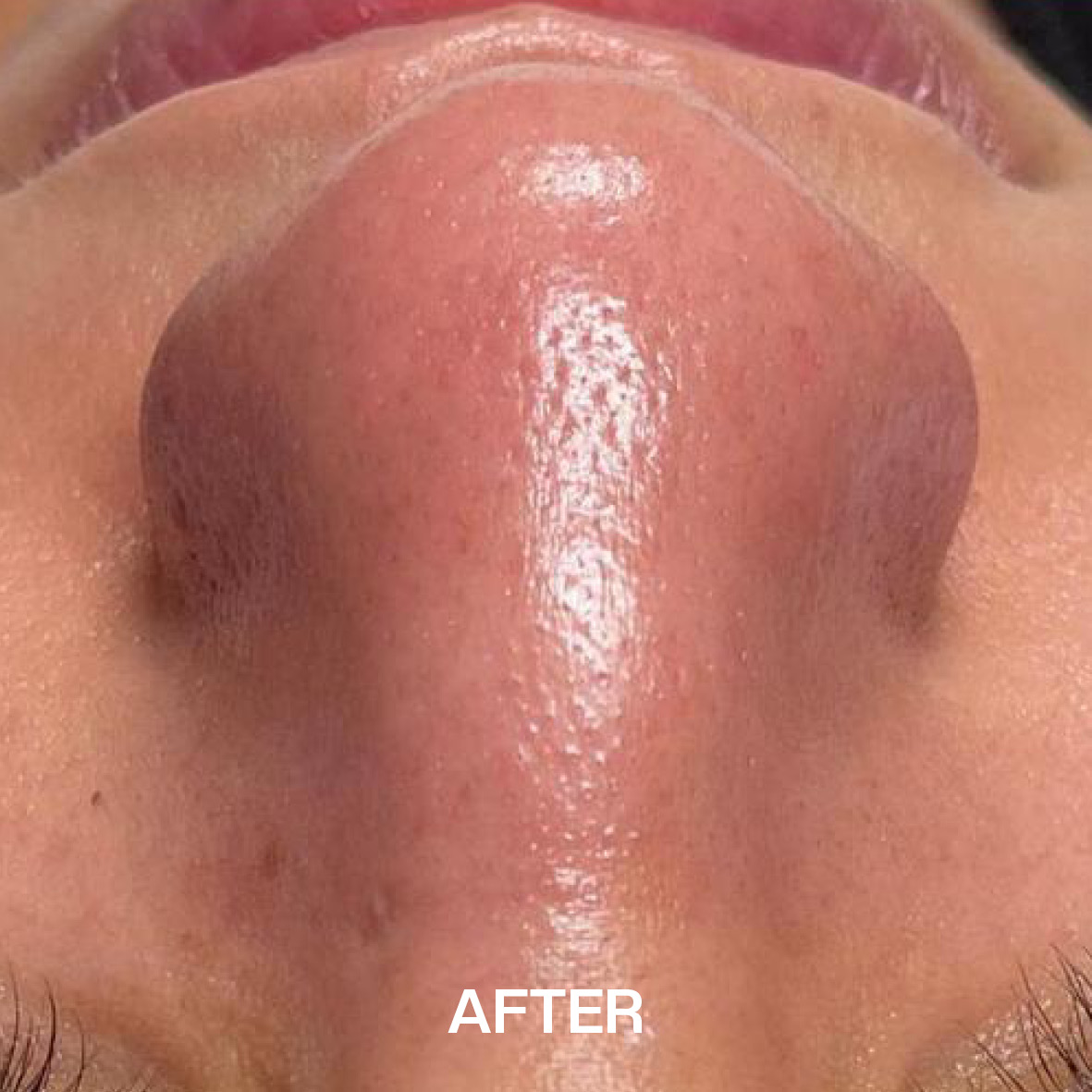 hydrafacial after