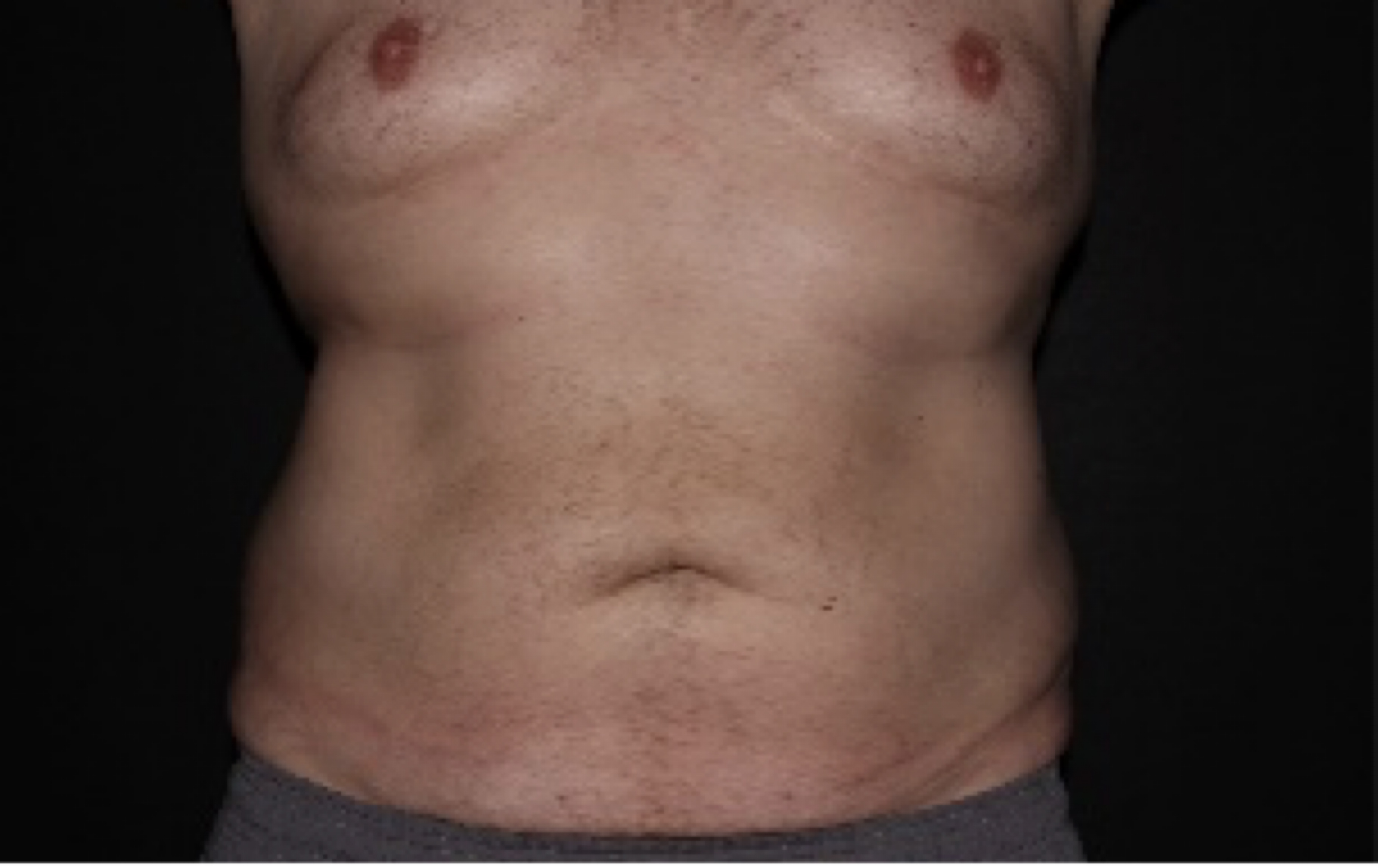 coolsculpting before and after belly