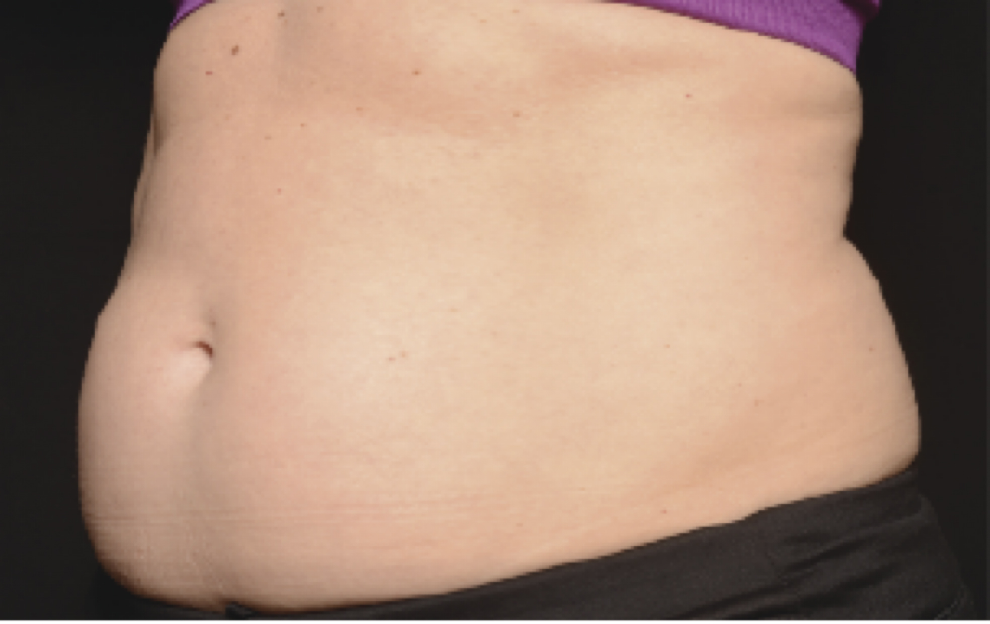 coolsculpting before and after belly