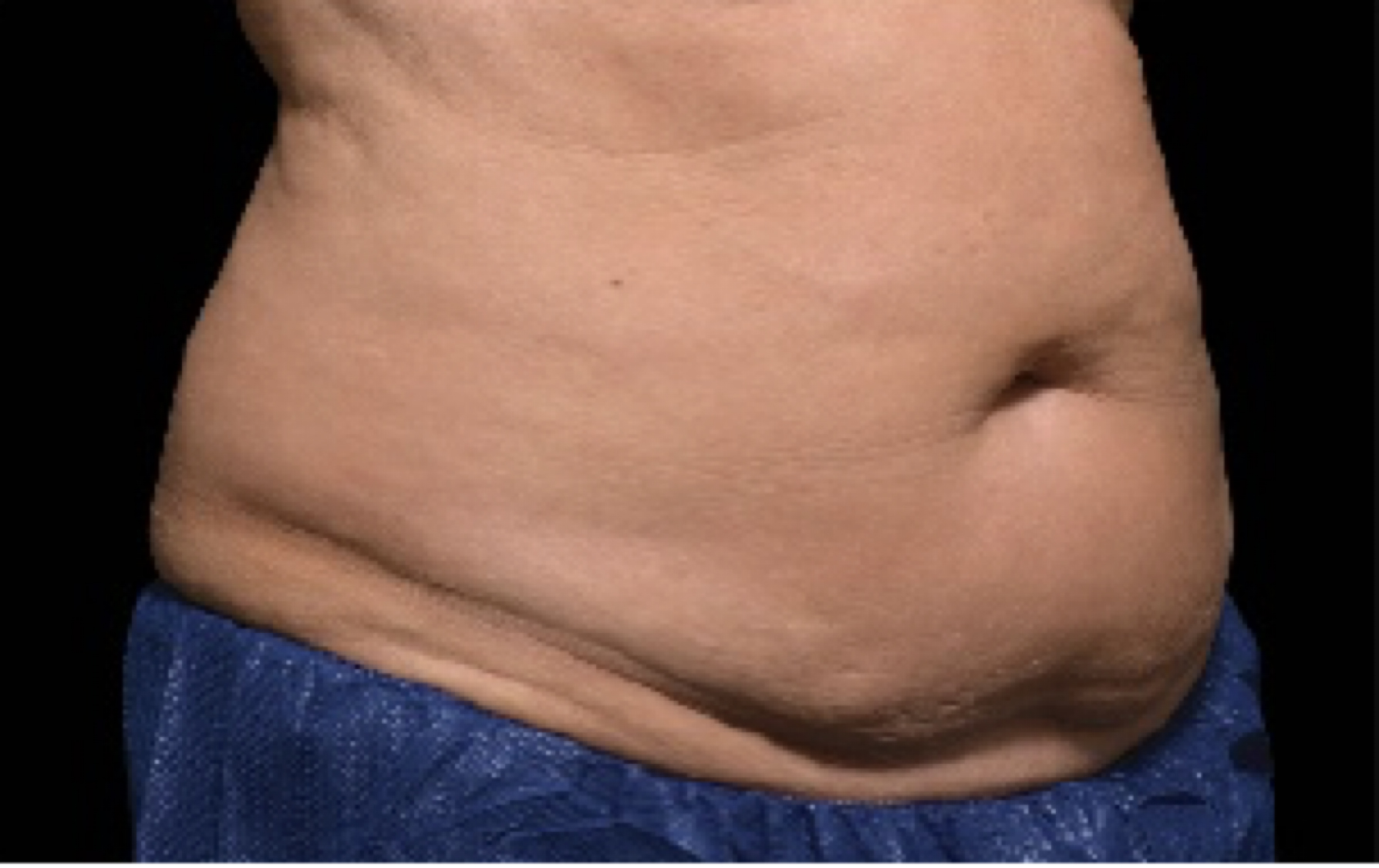 coolsculpting Stomach