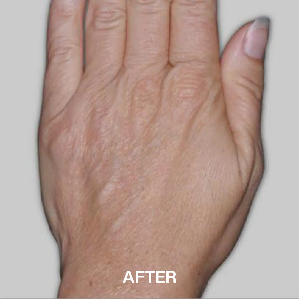hand rejuvenation after