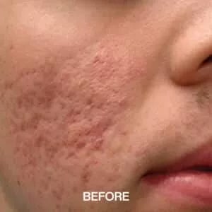 acne scar treatment liverpool