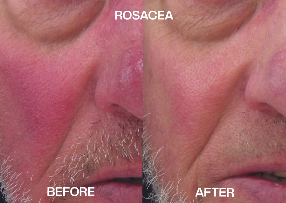 rosacea treatment before