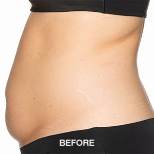 fat freezing before and after