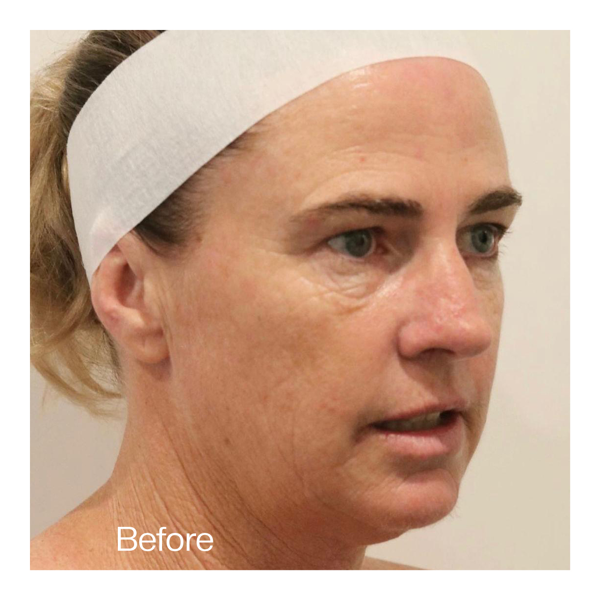 co2 laser resurfacing near me