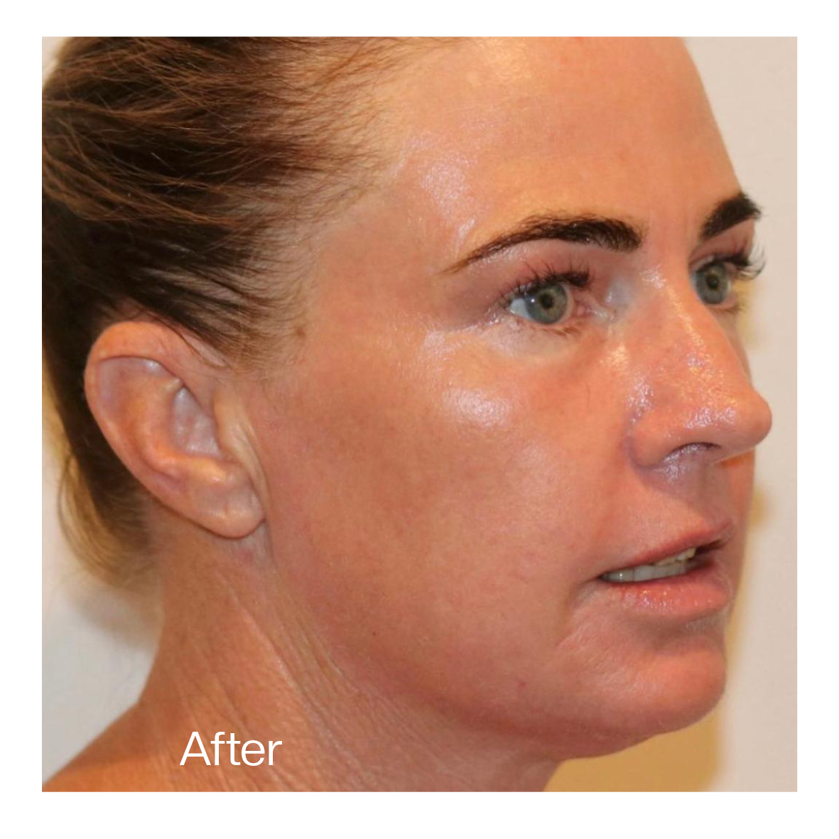 co2 laser resurfacing Liverpool