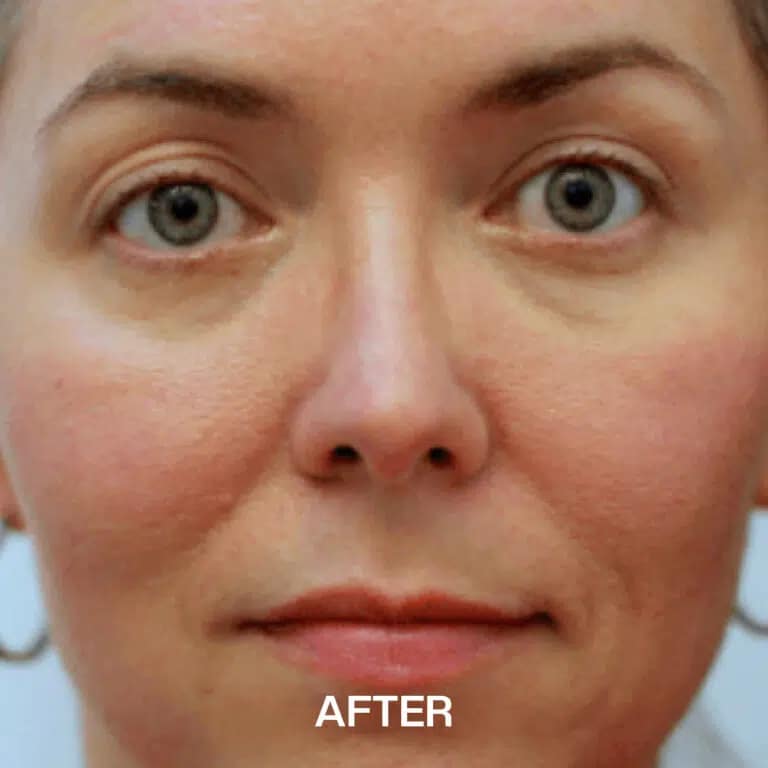 best skincare for rosacea