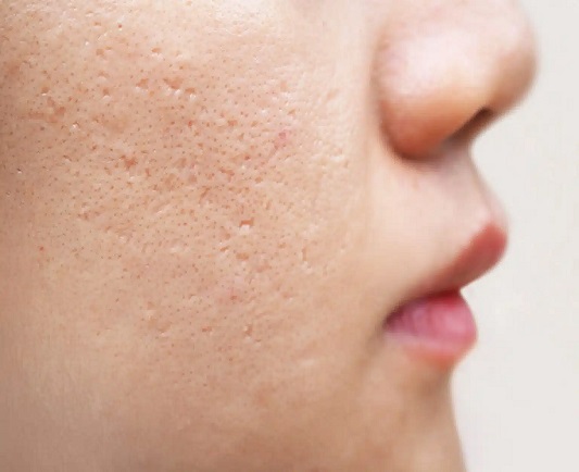 acne scar treatment