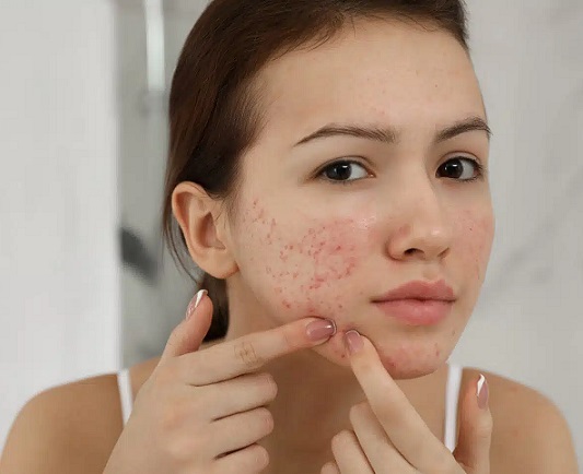 Acne treatments Liverpool, patient squeezing spots in mirror