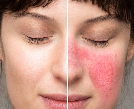 ROSACEA TREATMENT LIVERPOOL