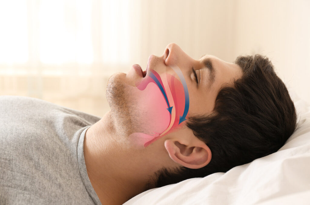 laser snoring treatment