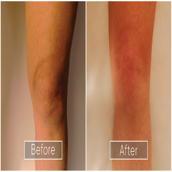 endolift before and after