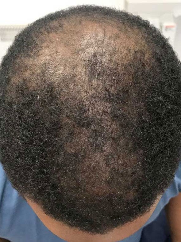 exosomes after