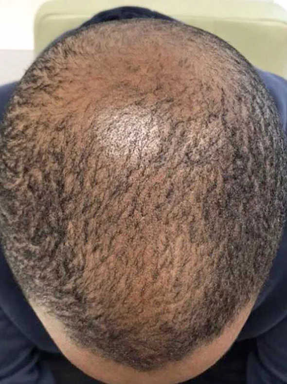 exosomes before