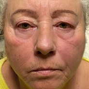 non-surgical facelift with permanent thread lifts after image