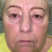 non-surgical facelift with permanent thread lifts before image