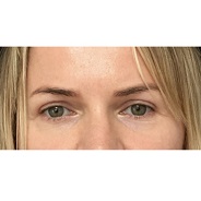 eyelid surgery blepharoplasty