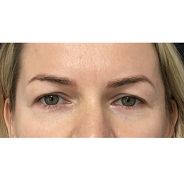 eye bag surgery