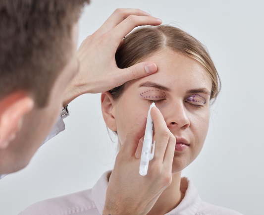 blepharoplasty