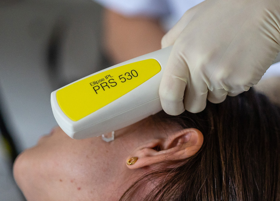 spider vein removal
