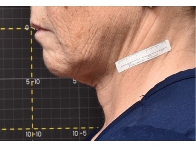 sofwave skin tightening near me