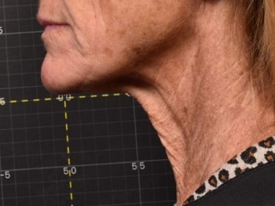 sofwave skin tightening