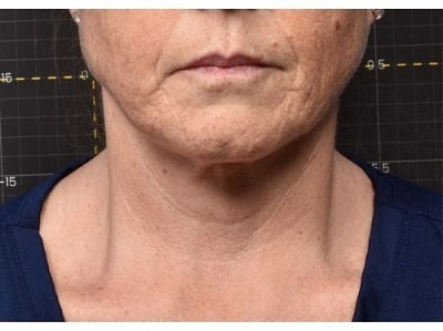 softwave therapy face