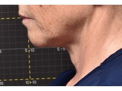 softwave therapy for face