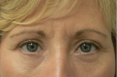 Lower Blepharoplasty Liverpool