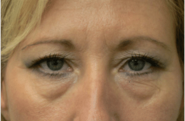 Lower Blepharoplasty