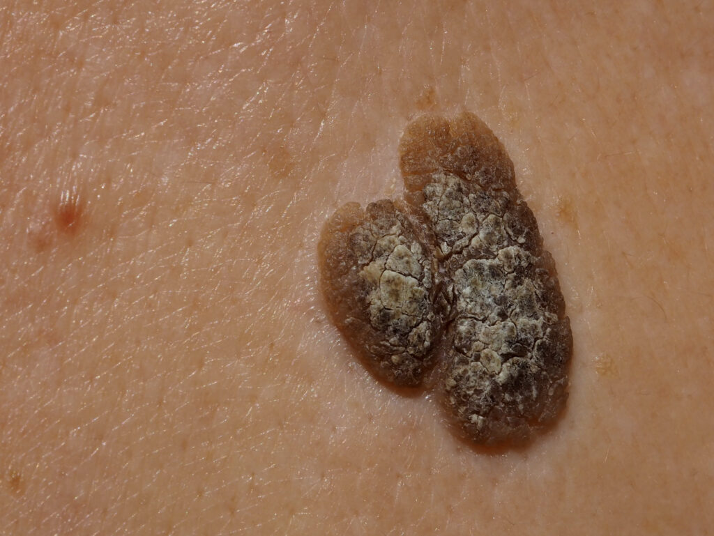 seborrhoeic keratosis removal liverpool