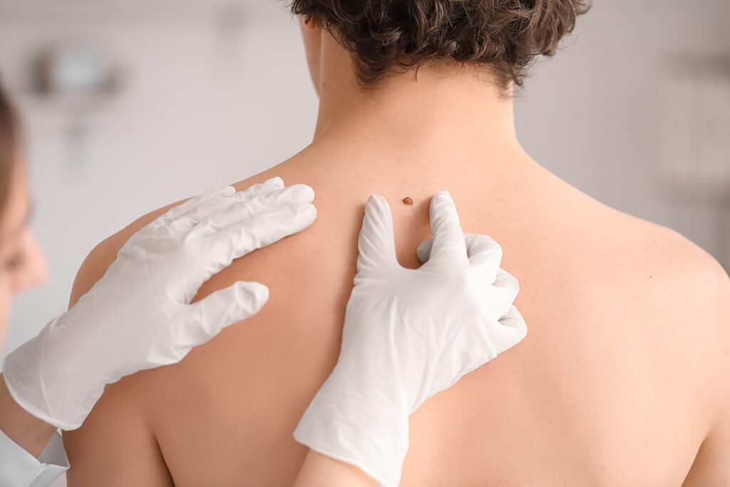 mole removal liverpool