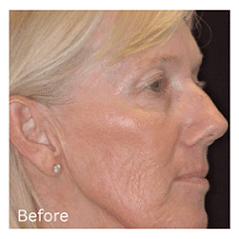 co2 laser eyelid lift