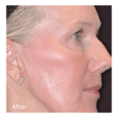 eyelid rejuvenation Liverpool