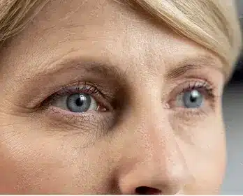 Eye Bag Removal in Liverpool