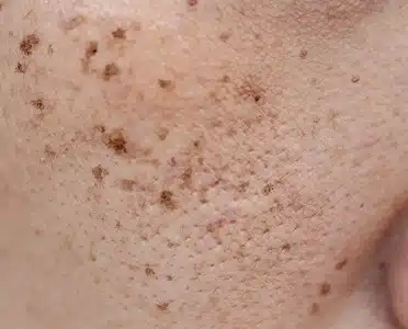 Skin Pigmentation Treatment Liverpool