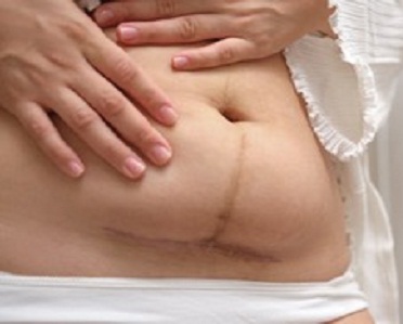 scar revision liverpool